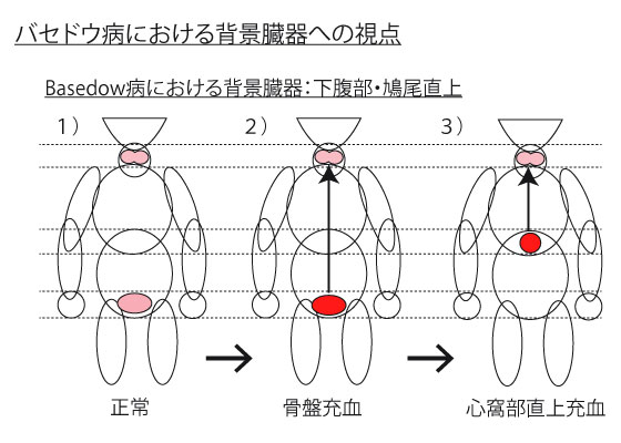 バセドウ病の原因臓器