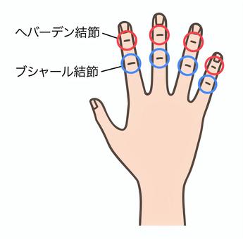 ヘバーデン結節